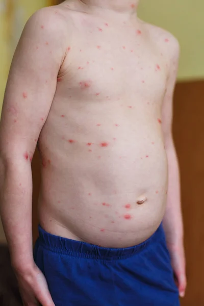 Baby met de waterpokken uitslag. Varicella virus of waterpokken zeepbel uitslag op kind. Dermatologie concept — Stockfoto