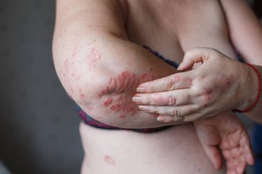 İnsanlar el, kol, kaşıntı kaşıntı, sağlık ve tıp konseptiyle kaşı. Egzama veya yandan sedef