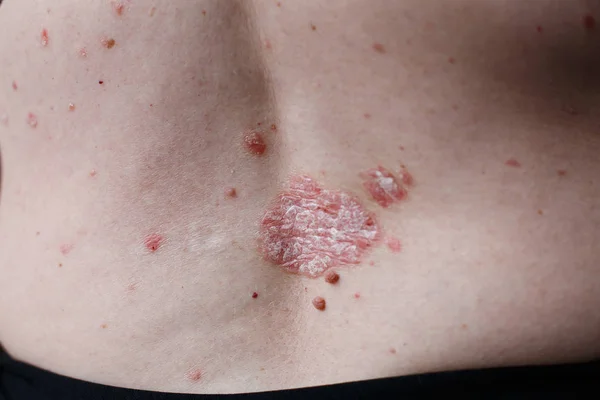 Huid van de psoriasis. Psoriasis is een auto-immune ziekte die de ontsteking van de huid van huid-oorzaak, rode en schilferige aantast. Eczeem-huid — Stockfoto