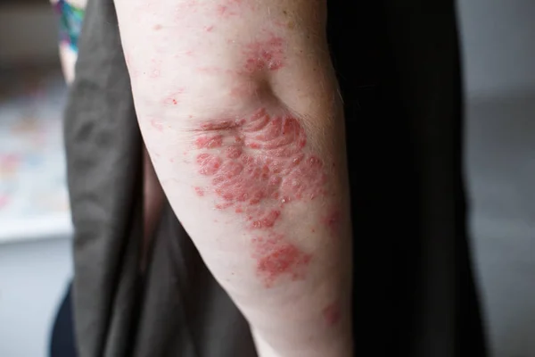 Psoriasis hud. Psoriasis är en autoimmun sjukdom som påverkar huden orsaka hudinflammation röd och fjällande. Eksem hud — Stockfoto