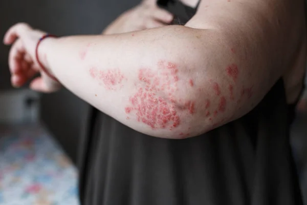 Peau de psoriasis. Le psoriasis est une maladie auto-immune qui affecte la peau provoque une inflammation de la peau rouge et squameuse. Eczéma cutané — Photo