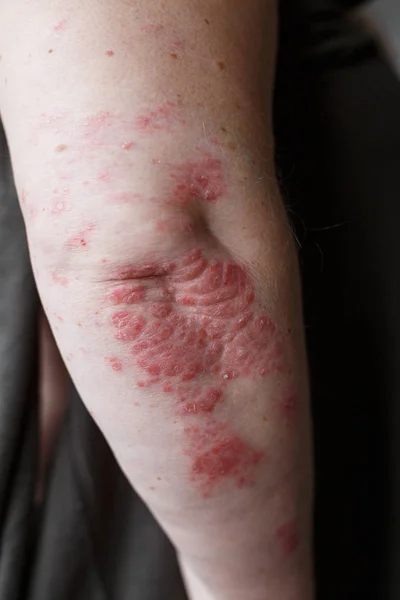 Schuppenflechte. Psoriasis ist eine Autoimmunkrankheit, die die Haut befällt und Hautentzündungen verursacht, die rot und schuppig sind. Ekzemhaut — Stockfoto