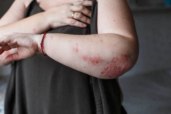 Schuppenflechte. Psoriasis ist eine Autoimmunkrankheit, die die Haut befällt und Hautentzündungen verursacht, die rot und schuppig sind. Ekzemhaut — Stockfoto