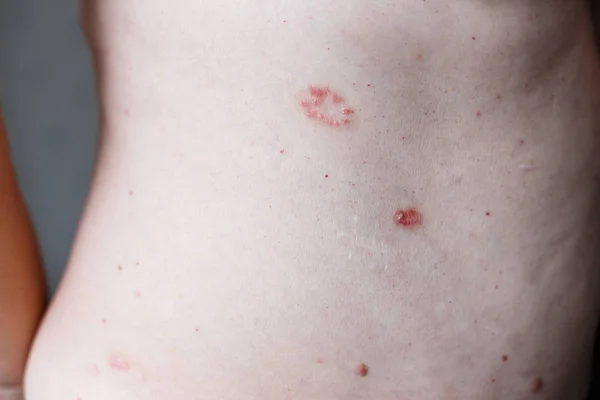 Schuppenflechte. Psoriasis ist eine Autoimmunkrankheit, die die Haut befällt und Hautentzündungen verursacht, die rot und schuppig sind. Ekzemhaut — Stockfoto