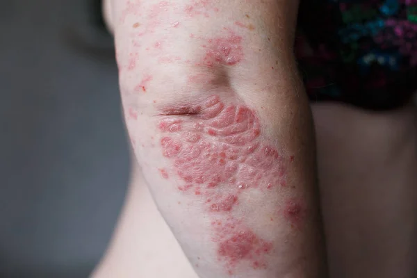 Łuszczyca skóry. Łuszczyca jest chorobą autoimmunologiczną, która wpływa na skórę przyczyny zapalenie skóry, czerwone i łuszcząca się. Wyprysk skóry — Zdjęcie stockowe