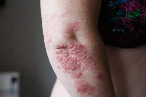 Schuppenflechte. Psoriasis ist eine Autoimmunkrankheit, die die Haut befällt und Hautentzündungen verursacht, die rot und schuppig sind. Ekzemhaut — Stockfoto
