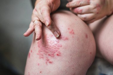 sedef, egzama ve diğer kuru cilt hastalıkları tedavisinde olduğu gibi lapa lapa cilt kurumasını bir yumuşatıcı uygulanıyor. Yatay fotoğraf