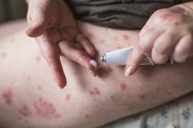 Merhem yandan. Tedavi ve hidrasyon cilt merhem uygulamak. Yatay fotoğraf. Boş kopya spase krem Tube