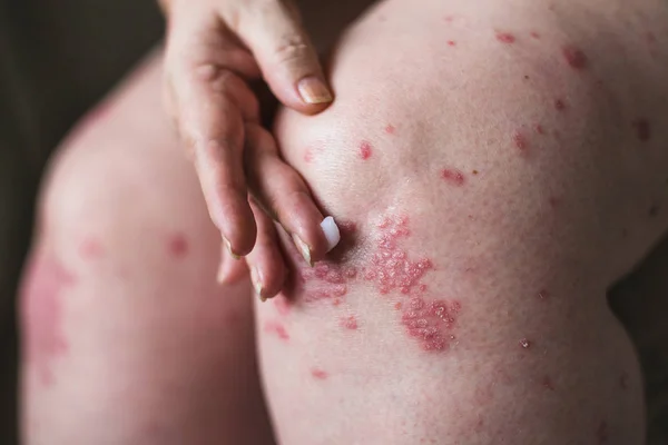 Aplicando um emoliente à pele seca escamosa como no tratamento da psoríase, eczema e outras condições de pele seca. Fotografia horizontal — Fotografia de Stock