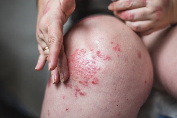 Aplicando um emoliente à pele seca escamosa como no tratamento da psoríase, eczema e outras condições de pele seca. Fotografia horizontal — Fotografia de Stock