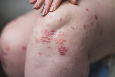 sedef, egzama ve diğer kuru cilt hastalıkları tedavisinde olduğu gibi lapa lapa cilt kurumasını bir yumuşatıcı uygulanıyor. Sağlık kavramı