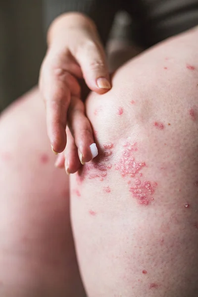 Aplicar un emoliente sobre la piel seca escamosa, como en el tratamiento de la psoriasis, el eccema y otras afecciones de la piel seca. Concepto de salud — Foto de Stock