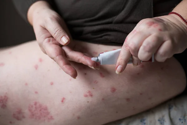 Anwendung eines Weichmachers auf trockene schuppige Haut wie bei der Behandlung von Schuppenflechte, Ekzemen und anderen trockenen Hauterkrankungen. Gesundheitskonzept — Stockfoto