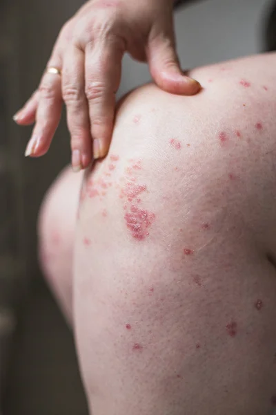 Menerapkan emollien untuk mengeringkan kulit bersisik seperti dalam pengobatan psoriasis, eksim dan kondisi kulit kering lainnya. Konsep kesehatan — Stok Foto