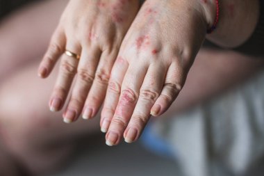 Psoriasis vulgaris plak, döküntü ve deride beyaz arka plan üzerinde izole yamalar ile kadının ellerinde. Otoimmün hastalığı genetik. Sağlık kavramı