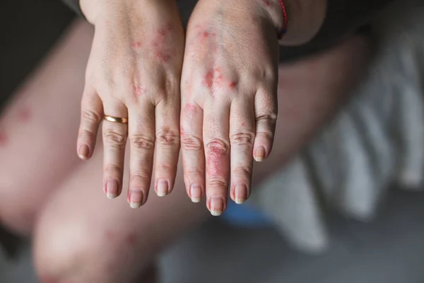 Psoriasis vulgaris op de handen van de dames met plaque, de uitslag en de vlekken op de huid, geïsoleerd op een witte achtergrond. Auto-immune genetische ziekte. begrip gezondheid — Stockfoto