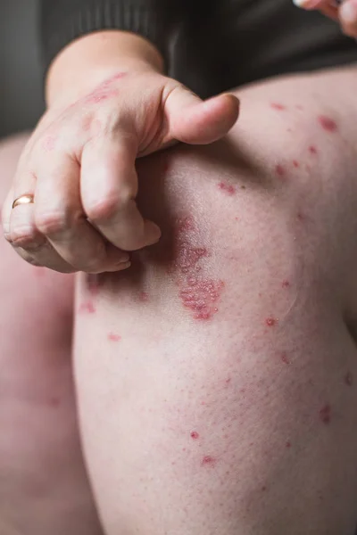 El problema con muchas personas - eczema en la mano. Fondo blanco. Mujer picazón piel . — Foto de Stock