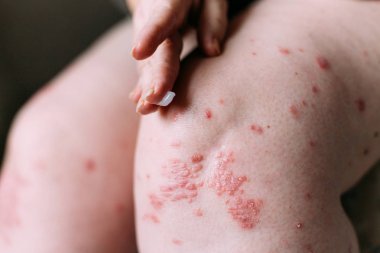 sedef, egzama ve diğer kuru cilt hastalıkları tedavisinde olduğu gibi lapa lapa cilt kurumasını bir yumuşatıcı uygulanıyor. Cilt sorunu kavramı