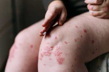 sedef, egzama ve diğer kuru cilt hastalıkları tedavisinde olduğu gibi lapa lapa cilt kurumasını bir yumuşatıcı uygulanıyor. Cilt sorunu kavramı