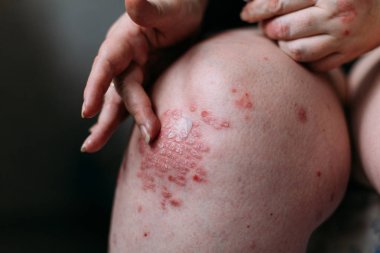 sedef, egzama ve diğer kuru cilt hastalıkları tedavisinde olduğu gibi lapa lapa cilt kurumasını bir yumuşatıcı uygulanıyor. Cilt sorunu kavramı