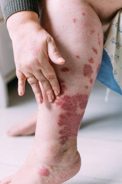 Egzama yandan birçok kişi ile-sorun. Yaşam tarzı arka plan. Kadın itchind cilt.