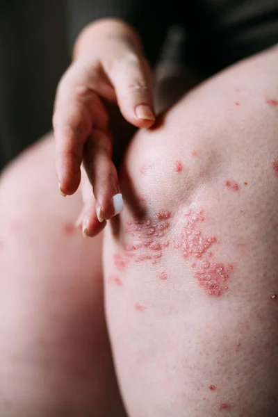 Aplicar un emoliente sobre la piel seca escamosa, como en el tratamiento de la psoriasis, el eccema y otras afecciones de la piel seca. Concepto de problema cutáneo — Foto de Stock