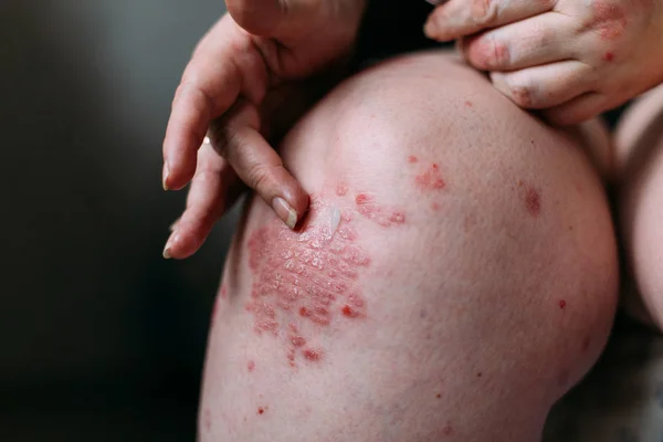 Anwendung eines Weichmachers auf trockene schuppige Haut wie bei der Behandlung von Schuppenflechte, Ekzemen und anderen trockenen Hauterkrankungen. Hautproblem-Konzept — Stockfoto