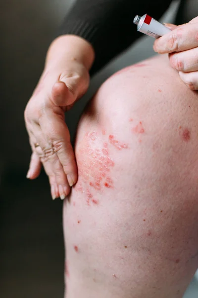 Anwendung eines Weichmachers auf trockene schuppige Haut wie bei der Behandlung von Schuppenflechte, Ekzemen und anderen trockenen Hauterkrankungen. Hautproblem-Konzept — Stockfoto