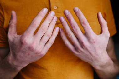 Sedef hastalığı derisi. Hastaların ciltlerinde kızarıklık ve pullanma var. Kronik hastalık tedavisi kavramı. Dermatolojik sorunlar. Erkeklerin ellerinde sert, azgın ve çatlak bir deri. Kuru cilt.
