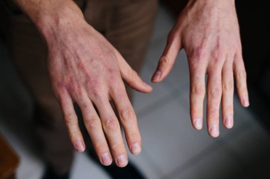 Sedef hastalığı derisi. Hastaların ciltlerinde kızarıklık ve pullanma var. Kronik hastalık tedavisi kavramı. Dermatolojik sorunlar. Erkeklerin ellerinde sert, azgın ve çatlak bir deri. Kuru cilt.