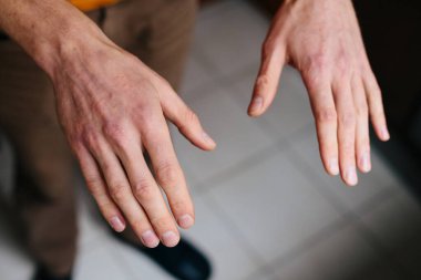 Sedef hastalığı derisi. Hastaların ciltlerinde kızarıklık ve pullanma var. Kronik hastalık tedavisi kavramı. Dermatolojik sorunlar. Erkeklerin ellerinde sert, azgın ve çatlak bir deri. Kuru cilt.