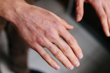 Sedef hastalığı derisi. Hastaların ciltlerinde kızarıklık ve pullanma var. Kronik hastalık tedavisi kavramı. Dermatolojik sorunlar. Erkeklerin ellerinde sert, azgın ve çatlak bir deri. Kuru cilt.
