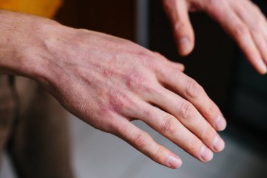 Sedef hastalığı derisi. Hastaların ciltlerinde kızarıklık ve pullanma var. Kronik hastalık tedavisi kavramı. Dermatolojik sorunlar. Erkeklerin ellerinde sert, azgın ve çatlak bir deri. Kuru cilt.