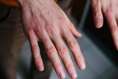 high angle view of hands suffering the dryness on the skin and deep cracks on knuckles. Eczema or psoriasis on hands clipart