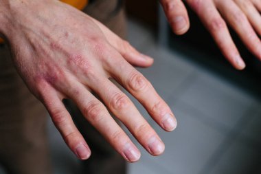 high angle view of hands suffering the dryness on the skin and deep cracks on knuckles. Eczema or psoriasis on hands clipart