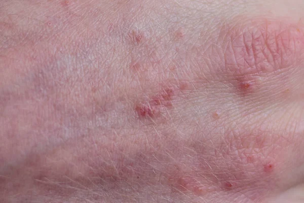 Łuszczyca skóry. Łuszczyca jest chorobą autoimmunologiczną, która wpływa na skórę powodować zapalenie skóry zaczerwienione i łuszczące. Makro zdjęcie dłoni — Zdjęcie stockowe