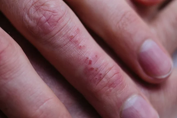 Psoriasis skin. Psoriasis is an autoimmune disease that affects the skin cause skin inflammation red and scaly. Macro photo of hands — Stock Photo, Image