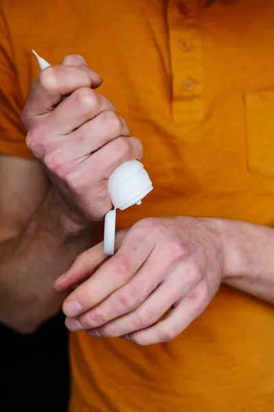 Anwendung eines Weichmachers auf trockene schuppige Haut wie bei der Behandlung von Schuppenflechte, Ekzemen und anderen trockenen Hauterkrankungen. Hautprobleme — Stockfoto