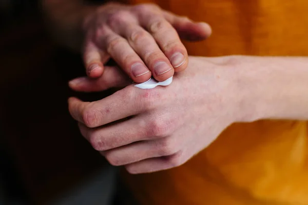 Pomada nas mãos de uma pessoa idosa. Reformado aplicando a pomada, cremes no tratamento de eczema, psoríase e outras doenças da pele — Fotografia de Stock