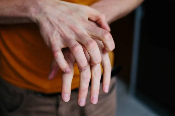 Man scratch oneself, dry flaky skin on hand with psoriasis vulgaris, eczema and other skin conditions like fungus, plaque, rash and patches. Autoimmune genetic disease. — Stock Photo, Image