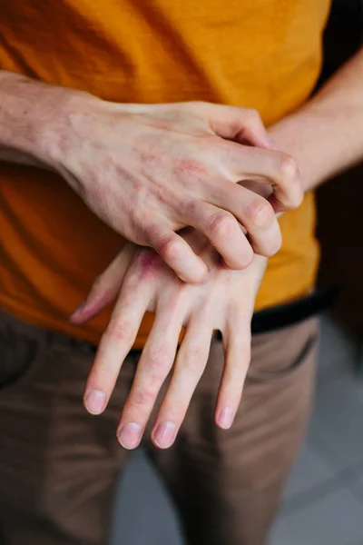 Homem coçar-se, pele seca escamosa na mão com psoríase vulgar, eczema e outras condições da pele, como fungos, placas, erupções cutâneas e manchas. Doença genética auto-imune . — Fotografia de Stock