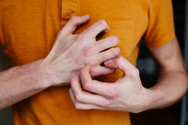 Man scratch oneself, dry flaky skin on hand with psoriasis vulgaris, eczema and other skin conditions like fungus, plaque, rash and patches. Autoimmune genetic disease. — Stock Photo, Image