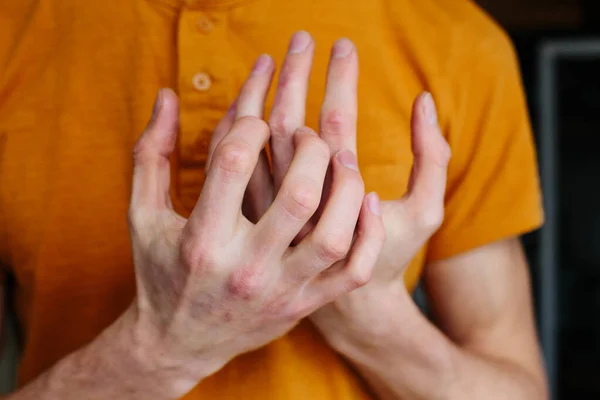 Hombres de cerca con comezón y arañazos a mano. Psoriasis o eczema en la mano. Piel alérgica atópica con manchas rojas. Concepto de salud —  Fotos de Stock