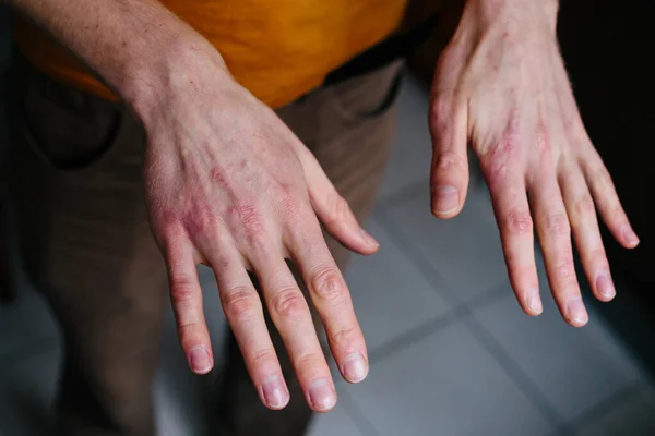 High angle view of hands suffering the dryness on the skin and deep cracks on knuckles. Eczema or psoriasis on hands — Stock Photo, Image