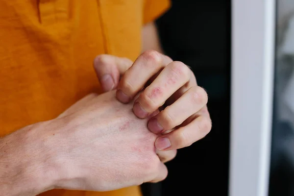 남자들은 손으로 가려움증 과긁히는 것을 막는다. 손에 건선이나 습진 이 있습니다. 빨간 점 이 있는 아토피 알레르기 피부. 히스의 개념 — 스톡 사진