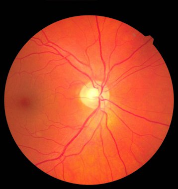 Retina, optik sinir ve makulayı gösteren göz bozukluklarını incele. Retina resmi, tıbbi fotoğraf, göz ekranı diyabetin ayrışması. Göz tedavisi kavramı.