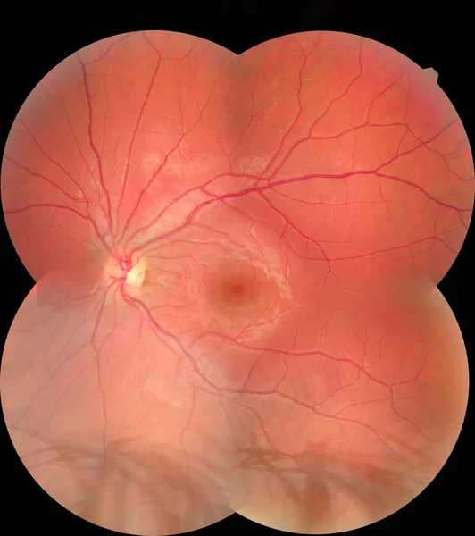 View inside human eye disorders showing retina, optic nerve and macula. Retinal picture ,Medical photo tractional eye screen retinal detachment of diabetes. Eye treatment concept. — 스톡 사진