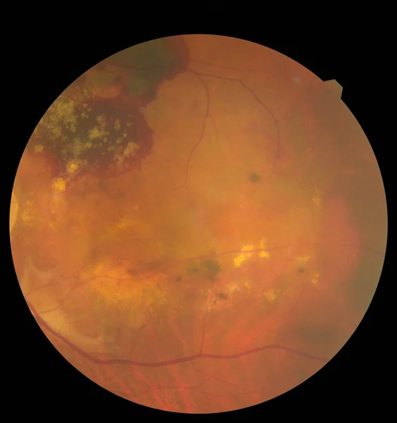 View inside human eye disorders showing retina, optic nerve and macula. Retinal picture ,Medical photo tractional eye screen retinal detachment of diabetes. Eye treatment concept. — 스톡 사진