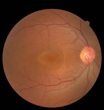 İnsan gözünün içine bak retina, optik sinir ve macula görünüyor. Sağlık kavramı