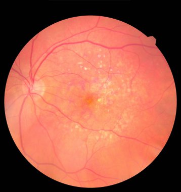 Medical photo retina diabetic retinopathy. Examination of the eye, diabetic retinopathy, ARMD clipart